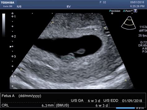 dating scan at 6 weeks